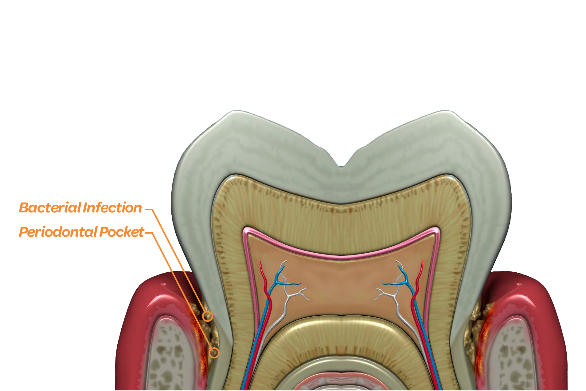 Bacteria that causes gum disease gathers in periodontal pockets below the gum line.