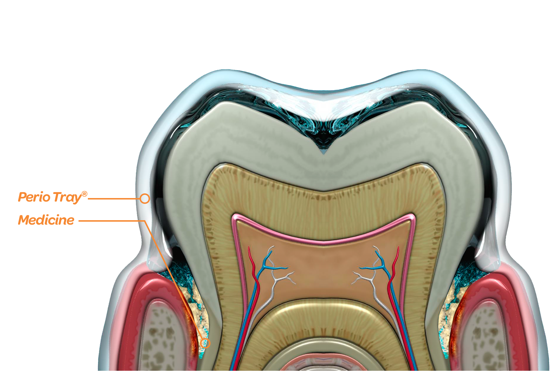 Graphic describing how the PerioProtect process works to treat gum disease.