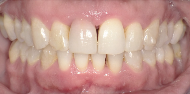 After Invisalign and PerioProtect treatment