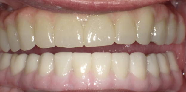 After upper and lower hybrid dentures