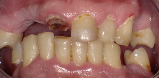 Before upper and lower hybrid dentures