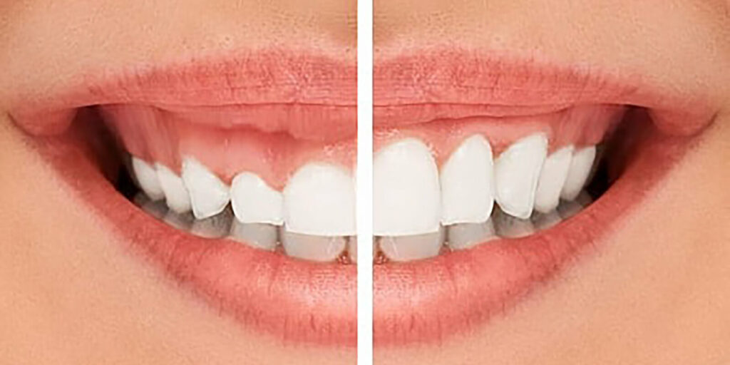 Gum lifts to reduce gummy smiles