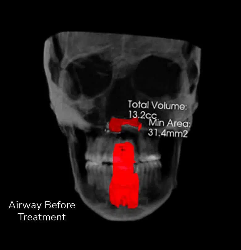 Before Vivos airway treatment